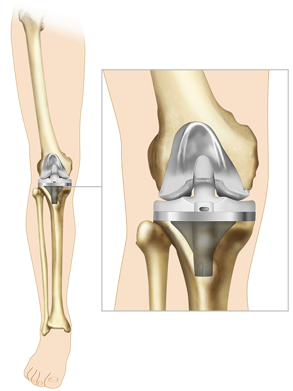 Knee Replacement Surgery Surgical Treatment Options Exactech