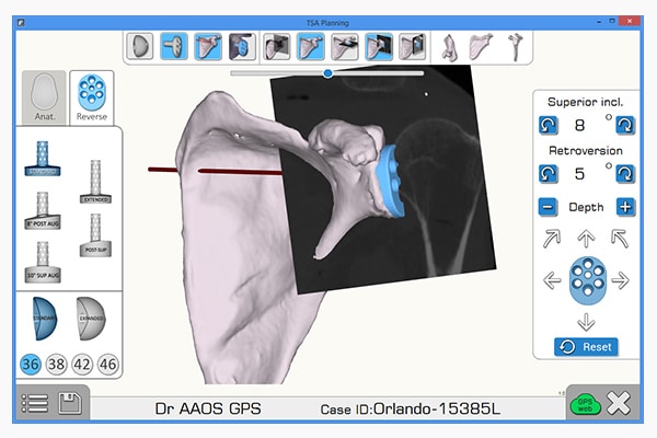 ExactechGPS Shoulder Application  Total Shoulder Arthroplasty  Exactech