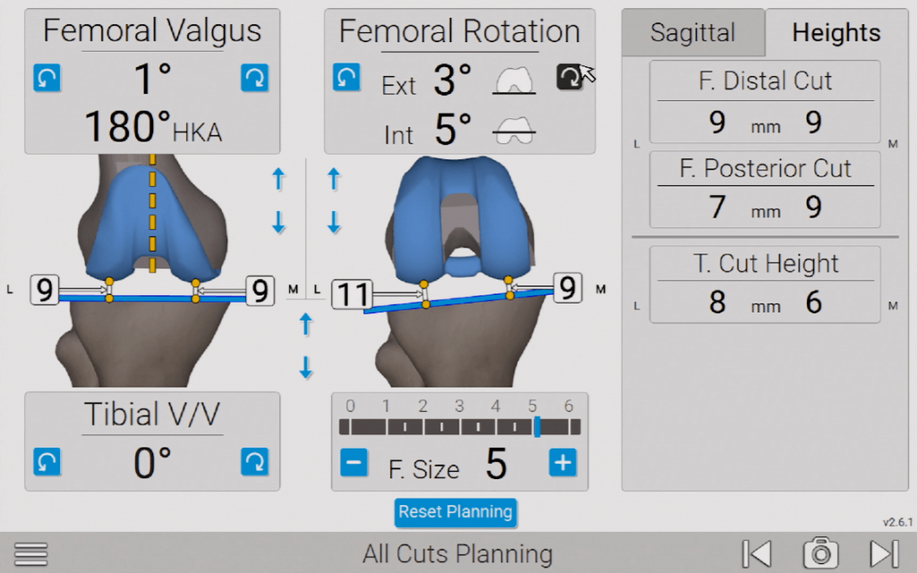 Exactechs Newton Knee Balancing Surgery With Joseph Locker Md