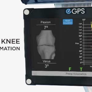 Exactech Knee Newton Knee GPS Screen