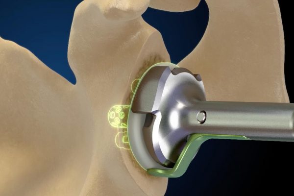 GPS Computer Navigation in Shoulder Arthroplasty